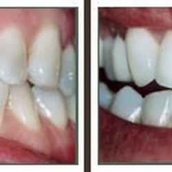 Tierrasanta Plaza Dental Care - Before_after_porcelain_veneers