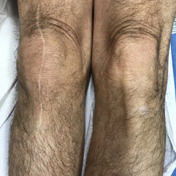 Larry M Gersten, MD - Replacement knee with scar is larger. - Orthopedists Near Me - Laguna Woods, California Larry M Gersten, MD - Replacement knee with scar is larger. - Orthopedists Near Me - Laguna Woods, California