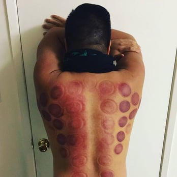 Marque Acupuncture - Had acupuncture and cupping done to my back and got instant relief! Thanks Joachim! - Acupuncture Near Me - Temecula, California