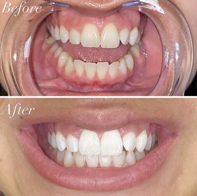 Whitening Before & After - Whitening Before & After Whitening Before & After - Whitening Before & After