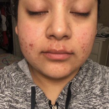 SkinCEO - Judy Saucedo - 1st session - Skin Care Near Me - Tustin, California