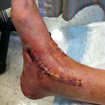 Santana Row - This is my ankle joint replacement. They still said I was a liar. - Shopping Centers Near Me - San Jose, California
