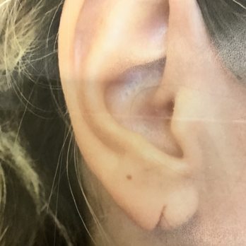 North Shore Aesthetics - Pre-procedure - fully-torn right earlobe - Cosmetic Surgeons Near Me - Northbrook, Illinois