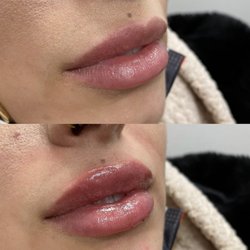 Lip Augmentation by Nurse Fay.