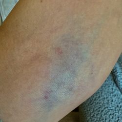 Quest Diagnostics - Blown vein