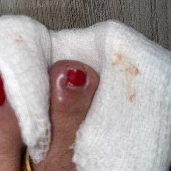 Fresh Salon & Spa - Infected toe - Nail Salons Near Me - Rodeo, California Fresh Salon & Spa - Infected toe - Nail Salons Near Me - Rodeo, California