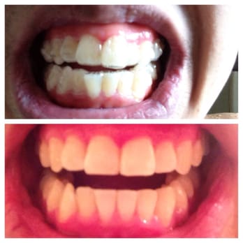 Highland Dental Center - Before and after. Thanks to Invisalign and Dr. Princy Rekhi - General Dentistry Near Me - Renton, Washington Highland Dental Center - Before and after. Thanks to Invisalign and Dr. Princy Rekhi - General Dentistry Near Me - Renton, Washington