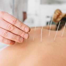Acupuncture Herbal Wellness Center - Upper back pain acupuncture