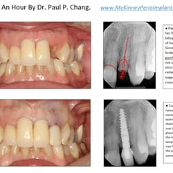 Drs, Chang and Tatum, Periodontics & Implant Center Of McKinney - Immediate Tooth Replacement With A Dental Implant by Dr. Paul P. Chang