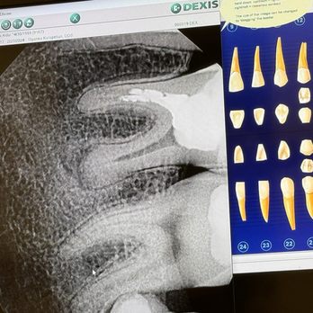 Kool Dentistry - This is my complex wisdom tooth that was lying horizontally hidden inside my gum and was completely, quickly and efficiently removed. - Cosmetic Dentists Near Me - Glendale, California