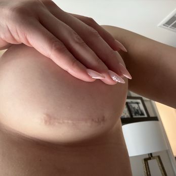 Smith Plastic Surgery - Ugly scarring with weird lining? Not just a straight line. - Cosmetic Surgeons Near Me - Las Vegas, Nevada