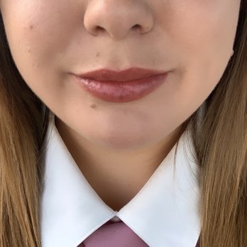 RiverwalkMD Aesthetics - 2 days after 1 syringe of lip filler - Medical Spas Near Me - Corona, California