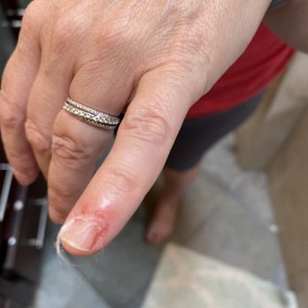 Polish'd Nail Bar - My wife's infected finger due to the horrible service she received. - Nail Salons Near Me - Shoreline, Washington Polish'd Nail Bar - My wife's infected finger due to the horrible service she received. - Nail Salons Near Me - Shoreline, Washington
