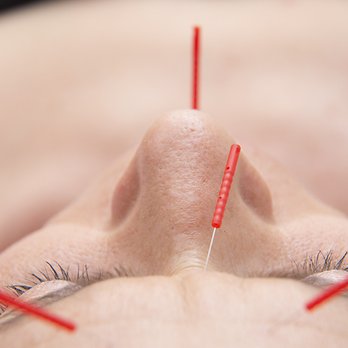 Twin Flame Radiant Wellness - Acupuncture Near Me - Los Angeles, California Twin Flame Radiant Wellness - Acupuncture Near Me - Los Angeles, California