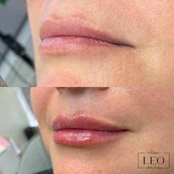 Leo Aesthetics Boutique - Subtle lip enhancement - Medical Spas Near Me - Granite Bay, California Leo Aesthetics Boutique - Subtle lip enhancement - Medical Spas Near Me - Granite Bay, California