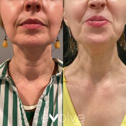 Evolve Med Spa - Jersey City - Jersey City NJ Neck Microneedling Before and After