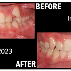 Cherubini Orthodontics - Invisalign Treatment - Before and After Beautiful Smile