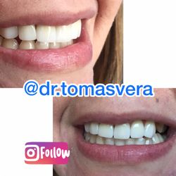 Dr. Tomás Vera  - Carillas de Porcelana - Porcelain Veneers