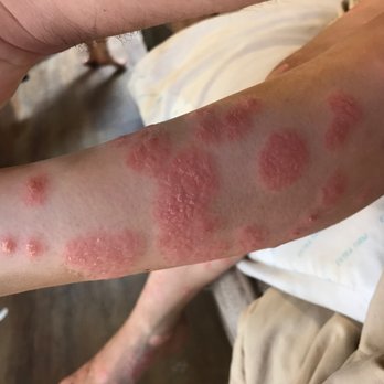 Tripoint Holistic Therapy - During MD care at Rady's, her body was covered like this. - Acupuncture Near Me - San Diego, California Tripoint Holistic Therapy - During MD care at Rady's, her body was covered like this. - Acupuncture Near Me - San Diego, California