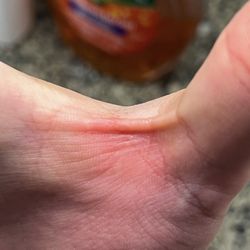 Skin Burn in Better Lighting