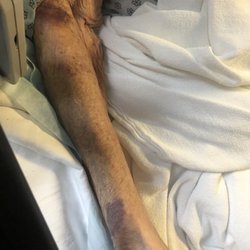 Morris View Healthcare Center - Bruises from being restrained.