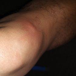 Hope House - "people before profits". this bed bug bite is recent & I have about 40 pictures.