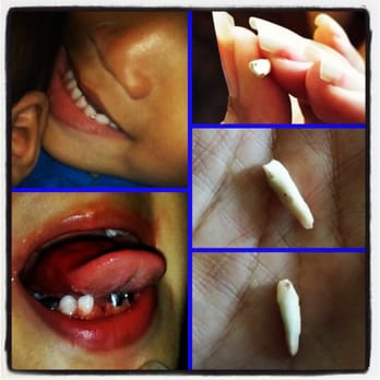 Leeward Pediatric Dentistry - Before and After! - Pediatric Dentists Near Me - Waipahu, Hawaii