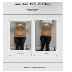 Anaheim Body Sculpting