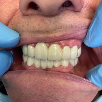 Pure Dental - Permanent Bridge with additional teeth added to bridge. - General Dentistry Near Me - Cathedral City, California Pure Dental - Permanent Bridge with additional teeth added to bridge. - General Dentistry Near Me - Cathedral City, California