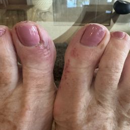 Scrapes from a pedicure Scrapes from a pedicure