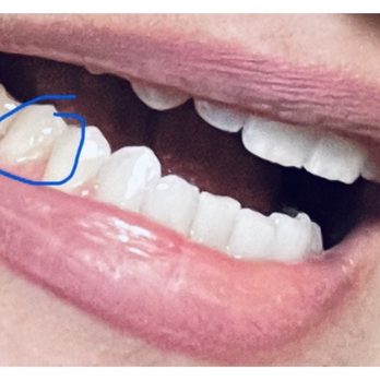 Rock Creek Dental - Repaired filling circled in blue. Amazing work. Thanks again! - General Dentistry Near Me - Rocklin, California Rock Creek Dental - Repaired filling circled in blue. Amazing work. Thanks again! - General Dentistry Near Me - Rocklin, California