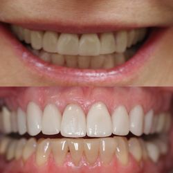 Dentistry at Maricopa - Old veneers. New veneers have a much improved color and a natural contour. By Dr Daniel Gibbons.
