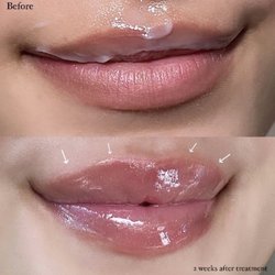 The Skin Agency - Glendale - Lip Flip