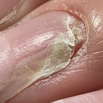 Polishhd Nail Bar - Beautiful fungus I ended up with. I'm traumatized. - Nail Salons Near Me - Phoenix, Arizona