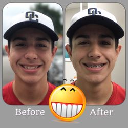 Medina Orthodontics - Just got braces today.