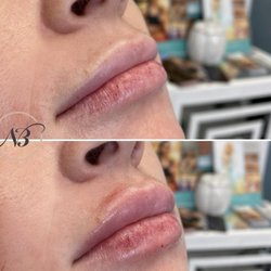 Nubella Med Spa - Nurse B injected these lippies Juvederm Ultra Plus to give them the perfect pout
