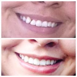 Vista Smiles - I had a bridge done almost a year ago and I am extremely happy with the results. I finally feel confident with my smile!