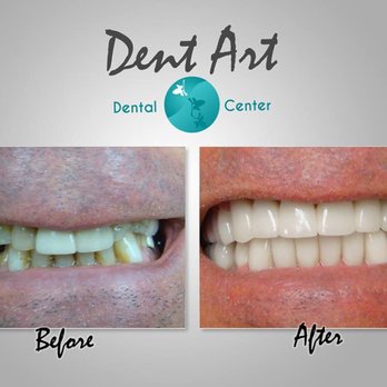 Dent Art - Veneers Before and After  Dent Art Center - Cosmetic Dentists Near Me - Tijuana, BCN