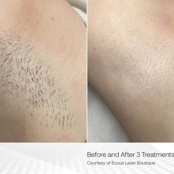 Sheesh Aesthetics - Laser Hair Removal - full body or individual areas. - Laser Hair Removal Near Me - Chino, California