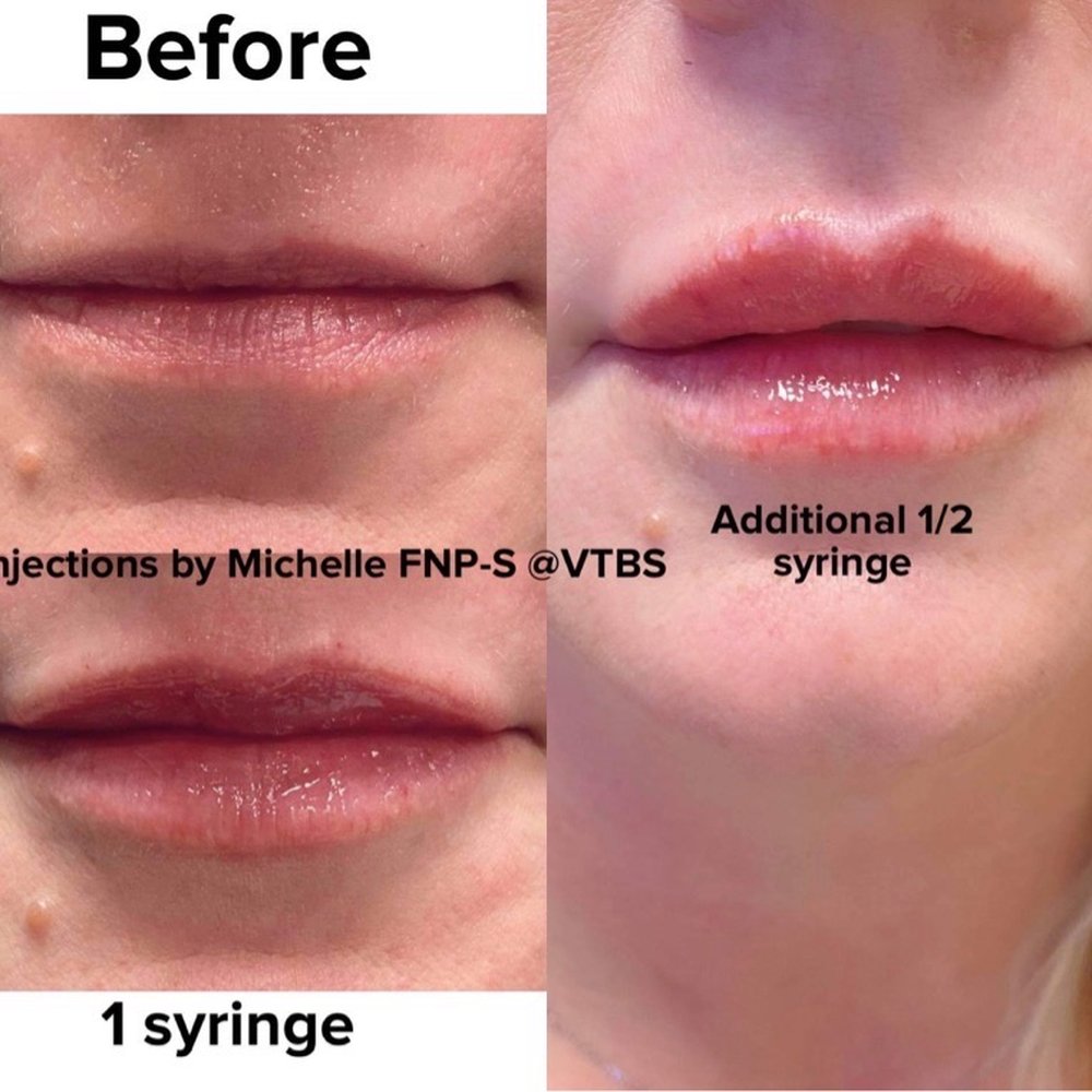 Venus Tan & Body Spa - Lip fillers. - Tanning Near Me - Humble, Texas Venus Tan & Body Spa - Lip fillers. - Tanning Near Me - Humble, Texas