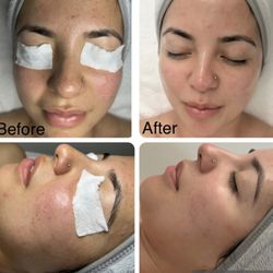 Powerful facial combined exfoliation plus high frequency, enzyme mask and LED green light