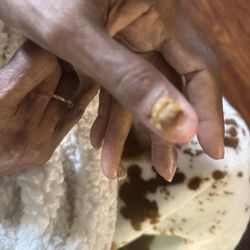 Lovely Nails - The fungal infection my mom received from this nail salon