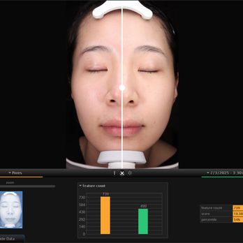 Blue Sky Laser & Tox - much smaller pores after BBL and MOXI combined treatment, by VISIA skin analysis comparison. - Medical Spas Near Me - Arlington, Virginia Blue Sky Laser & Tox - much smaller pores after BBL and MOXI combined treatment, by VISIA skin analysis comparison. - Medical Spas Near Me - Arlington, Virginia