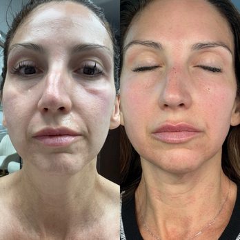 Newport Beach Skin Tightening - Before and after... just an hour apart! - Medical Spas Near Me - Costa Mesa, California Newport Beach Skin Tightening - Before and after... just an hour apart! - Medical Spas Near Me - Costa Mesa, California