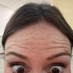 SF Aesthetics and Laser Center - Poor result from $1000 of Dysport