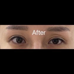 BAE Cosmetic Surgery - After 1st surgery