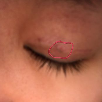 Aesthetic KS - Still have stitches left in my eyelid. Bumpy scar - Cosmetic Surgeons Near Me - Los Angeles, California Aesthetic KS - Still have stitches left in my eyelid. Bumpy scar - Cosmetic Surgeons Near Me - Los Angeles, California