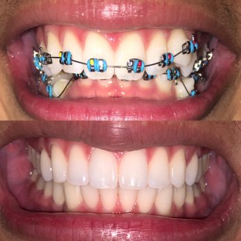Care Orthodontics - Orthodontists Near Me - San Jose, California