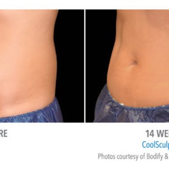 Buffalo Laser Spa - Laser Hair Removal Near Me - Williamsville, New York