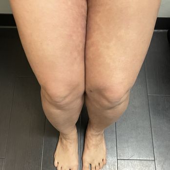 Khuu Dermatology - After 4 months of being their patient - Dermatologists Near Me - Mountain View, California
